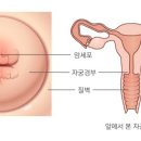 자궁암 무엇인가 이미지