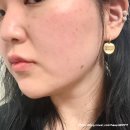 리쥬란러힐러효과 가격 통증 유지기간 세종피부과 후기
