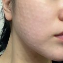 리쥬란힐러 후 강남역피부과 추천 손주사 후기