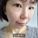 온더아셀 | 신논현 피부과에서 쥬브아셀 스킨부스터 받고온 후기!