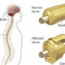 급성 염증성 탈수초성 다발성 신경병증[acute inflammatory demyelinating polyneuropathy, AIDP] 이미지