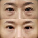옳은손성형외과 | 옳은손성형외과 하안검수술 추천하는곳