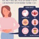 여성 방광염 증상 원인, 약 항생제 (급성 만성, 간질성, 방광 통증, 피, 자연) 이미지