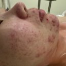 양덕동303 | 마산 양덕동 여드름 흉터. 색소침착, 재생 필 관리가 먼저인 이유