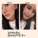 럭스메디컬 | 강남역피부과 전문의, 나비존 모공 피코프락셀 레이저 후기 통증, 효과!