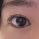 이상열 | [리뷰]성인 안검내반 1년 뒤 후기(ft.우리연세안과)