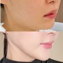 같지만 다른 얼굴 | 노원피부과 :얼굴 온다리프팅 6만줄 브이올렛 4cc 후기
