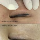 미작프렌차이즈 | 아이라인 문신제거 2회차 후기, 고통 아픔 정도. 강남 잠실 아이라인 문신제거 미작뷰티 강남본점