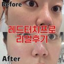 진레드 | 동탄피부과 레드터치프로 콜라겐레이저 후기! 피부탄력,기미 주근깨 좋아진 썰