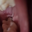 미소진약국 | 부산미소진치과 매복사랑니 발치 후기(통증, 붓기 등)