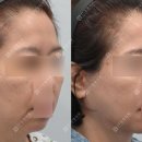 면목성심외과의원 | 거상 수술의 효과를 극대화하는 방법, 안면목거상 + 근육묶기 케이스