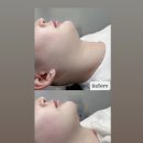 에스테틱 수수 | 광주 피부관리 추천 | 계림동 수수한에스테틱 브이라인 관리 후기