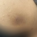 강북유통 | 엉덩이밑 착색이 고민이라면? 강북노원미아 더멜라닌케어로 바디착색부위 환하게 밝히자!
