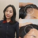 생생헤어 | 비절개모발이식비용｜헤어모발이식 9개월 차 생생 후기 (4~9개월 헤어라인 변화)