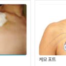 항암 치료 중 시술하는 케모포트(Chemoport) 관리법 이미지