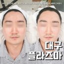 대구 플라즈마 리얼후기 써마지 리프팅 (feat. 아미뷰티아카데미 )