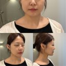 플러스미피부과의원 | 마산피부과 친절한미소의원 미글로우 후기, 직접 받아본 리프팅 솔직 리뷰