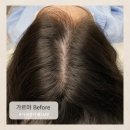 가비뷰티랩 | 두피문신, 단순한 커버가 아닌 ‘인생의 자신감’을 복원하는 기술