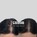 원도안로-23 | (노단머)대전두피문신 “도트바이림”에서 엄마 정수리 탈모관리 후기