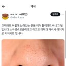 내 코 이런데 코수술했는데도 레이저로 조져도 됨?? 이미지