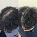 센스쟁이 | 인천두피문신 고민 끝! 아빠도 10년은 젊어 보이게 만든 혜지오 후기✨