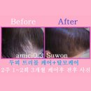 두피 탈모 아미치 0.3 수원점 이미지
