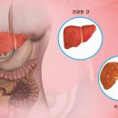 비알코올성 지방간 이미지