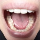 청주지웰유디치과의원 | 청주 치과 추천 : 유디치과 청주지웰점 스케일링/레진/금니 후기