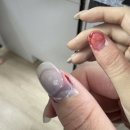 손톱들림, 손톱빠짐, 손톱뿌리 뽑혔을때 대처방법/손톱뽑기 고통, 비용 찐후기