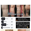 주식회사 닥터핏 | 바디셀트 라인닥터 압박밴드 2차 공구 (내돈내산 후기!) 하지정맥류 하체비만 꿀팁!