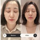 [둔천동 스킨부스터 리움한의원] 첫 스킨부스터 리네에르부터 추나한방치료까지 시간단축 패키지 만족후기