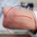 근로복지공단 창원병원에서 오신 산재 손님 의수 제작