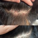 (주)윌스파인 | 퓨어벨 에스테틱 | 내돈내산 헤드스파 8회 후 비포-애프터 찐후기