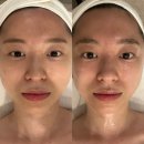 이화메디케어 | 이대 피부관리 미즈고데이스파 얼굴 윤곽 후 물광, 리프팅 대박 비포 애프터