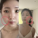 레디원성형외과의원 | 무이성형외과 사각턱보톡스 효과 후기 자연스러운 얼굴 라인 변화