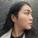 바라던 핏 | 신논현성형외과 바라던핏 얼굴지방분해주사 효과 윤곽주사 후기