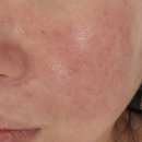 씨유서구청라한신점 | 청라피부관리 뽐에스테틱 피부진단을 통한 맞춤 피부관리 후기