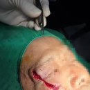 유어타임성형외과의원 | 노년 환자 열상에서 주의할 점들