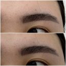 인더라인25시편의점 | 김포 무통증 잔흔제거 리얼 후기 | 리턴세럼 시술로 반영구 아이라인 눈썹 제거하기