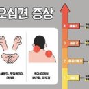 어깨 오십견 운동 근막통증증후군, 왼쪽어깨통증원인 이미지