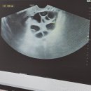 주사 시작!] 난임부부 시술비 지원신청/폴리트롭/고날에프/가니레버/데카펩틸 맞으며 난자 채취 준비하기