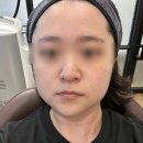 [강남/신논현] 조은날의원 피부과 스킨부스터 솔직후기