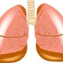 폐암에 대한 궁금증과 치료 방법 이미지