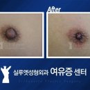 실루엣성형외과 유두축소 이미지