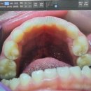 익산하나어린이치과의원 | 아이 충치는 크라운 또는 레진 // 진료 중 웃음가스 투입 가격공유 :: 익산하나어린이치과 방문후기