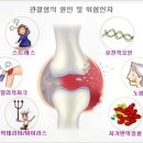 [인공관절치환술]무릎관절이란 무엇일까요??무릎관절염증상 이미지