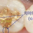 수석치과기공소 네이버블로그