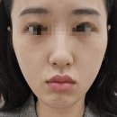 원레이져 | [수원 흑자 치료] 내돈내산 원데이색소 레이저 후기 | 2주 전후사진 대만족