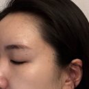 트리플 | 압구정피부과 피코트리플 후기