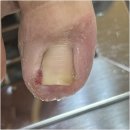 대덕대로168번길 | 대전 탄방동 내성발톱 아픈발톱 드디어 해결 성공 후기 네일의아침 내성발톱 무좀 발각질 네일 문제성발